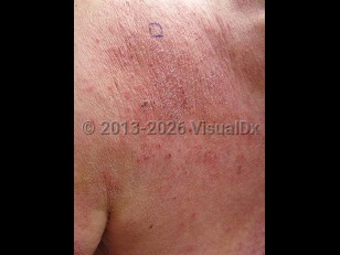 Clinical image of Chronic eczematous eruptions of the aged - imageId=7087103. Click to open in gallery.  caption: 'Scaly and crusted erythematous plaques on the upper back.'