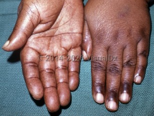 Clinical image of Vitamin B12 deficiency - imageId=7114227. Click to open in gallery.  caption: 'Hyperpigmented palmar macules and prominent pigmentation in palmar creases and over interphalangeal joints.'