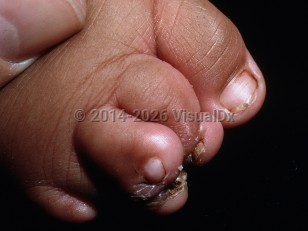 Clinical image of Pseudoainhum - imageId=7139648. Click to open in gallery.  caption: 'Crusted constriction bands on the toes.'