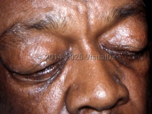 Clinical image of Obesity hypoventilation syndrome - imageId=7225731. Click to open in gallery.  caption: 'Periorbital edema.&nbsp;'