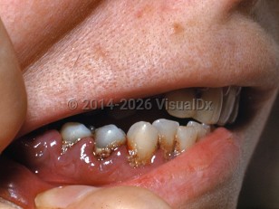 Clinical image of Acute myeloid leukemia - imageId=7275584. Click to open in gallery.  caption: 'Gingival hypertrophy and dental plaque around tooth margins.'
