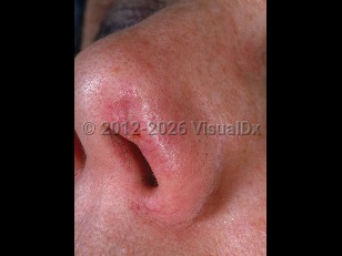 Clinical image of Microcystic adnexal carcinoma - imageId=730915. Click to open in gallery.  caption: 'A depressed, crusted, telangiectatic plaque on the nasal sill.'