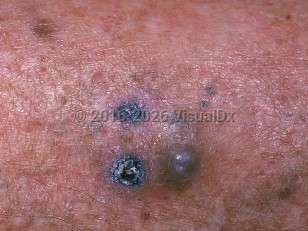 Clinical image of Metastatic cutaneous melanoma - imageId=731135. Click to open in gallery.  caption: 'A close-up of a cluster of black and deep gray papules, and background sun-damaged skin.'