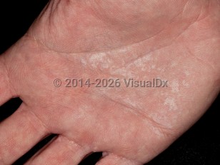 Aquagenic wrinkling of the palms