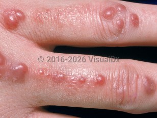 Multicentric reticulohistiocytosis