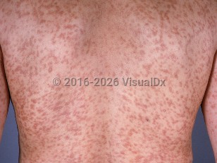 Mastocytosis in adults