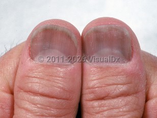 Longitudinal melanonychia