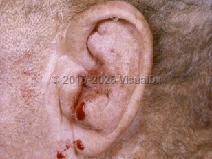 Perichondritis