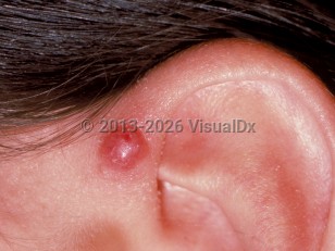 Angiolymphoid hyperplasia with eosinophilia