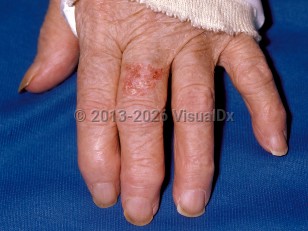 Clinical image of Squamous cell carcinoma in situ - imageId=75121. Click to open in gallery.  caption: 'A well-demarcated, scaly, erythematous plaque on the dorsal finger.'