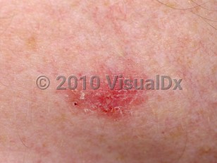 Superficial basal cell carcinoma