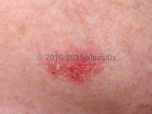 Superficial basal cell carcinoma