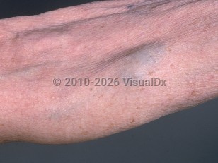 Blue rubber bleb nevus syndrome