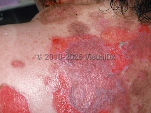 Pemphigus vulgaris