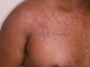 Parvovirus B19 infection