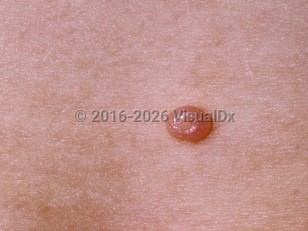 Molluscum contagiosum (pediatric)