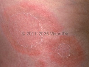 Clinical image of Erythema annulare centrifugum - imageId=7644. Click to open in gallery.  caption: 'A close-up of two confluent annular and erythematous plaques with central collarettes of scale.'