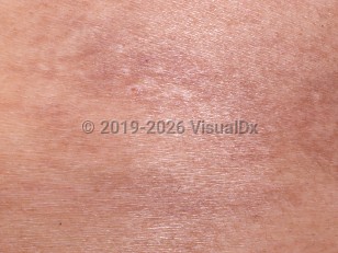 Clinical image of Hereditary coproporphyria - imageId=765887. Click to open in gallery.  caption: 'A close-up of tiny round crusts and scarring.'