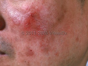 Pemphigus erythematosus