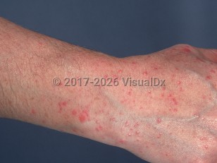 Clinical image of Polymorphous light eruption - imageId=766208. Click to open in gallery.  caption: 'Multiple erythematous papules and papulovesicles on the dorsal hand and forearm.'