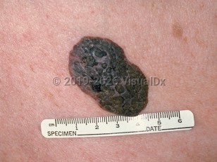 Seborrheic keratosis