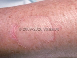 Porokeratosis (linear, Mibelli, plantar, ptychotropica)