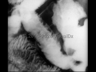 Imaging Studies image of Yersinia enterocolitica infection - imageId=7684417. Click to open in gallery. 