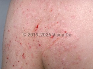 Pediculosis corporis