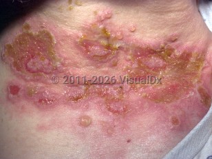 Paraneoplastic pemphigus