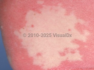 Pityriasis rubra pilaris
