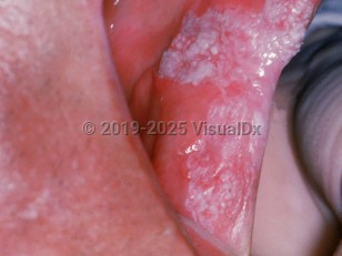 Leukoplakia
