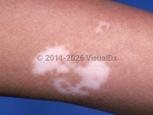 Vitiligo