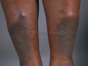 Pretibial myxedema