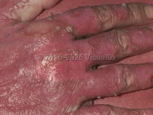 Clinical image of Erythrodermic psoriasis - imageId=784383. Click to open in gallery.  caption: 'Diffuse erythema and thick scales over the dorsal hand in a patient with erythrodermic psoriasis.'