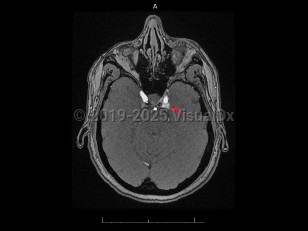 Imaging Studies image of Carotid-cavernous fistula - imageId=7872355. Click to open in gallery.  caption: '<span>Axial post-contrast MR image demonstrates abnormal opacification of the left cavernous sinus, consistent with  carotid-cavernous fistula.</span>'
