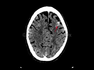 Subarachnoid hemorrhage