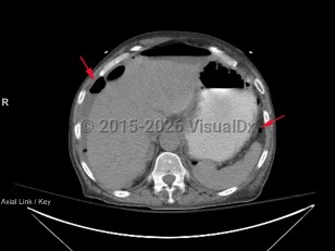 Bowel perforation