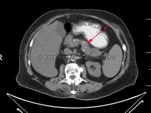 Chronic pancreatitis