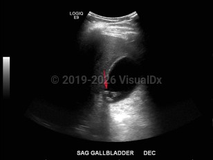 Biliary calculus