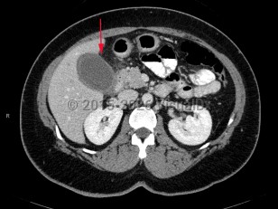 Imaging Studies image of Acute cholecystitis - imageId=7878656. Click to open in gallery.  caption: '<span>CT scan of the abdomen demonstrating distended gallbladder with wall thickening and inflammatory changes in the surrounding fat.</span>'