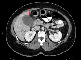 Acute cholecystitis