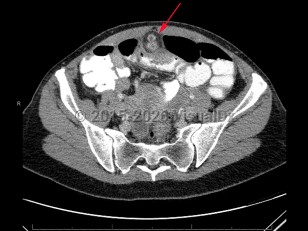 Imaging Studies image of Meckel diverticulum - imageId=7879679. Click to open in gallery.  caption: '<span>CT scan of abdomen and pelvis demonstrating enhancing nodular focus extending from ileum, which was pathology-proven Meckel diverticulitis.</span>'