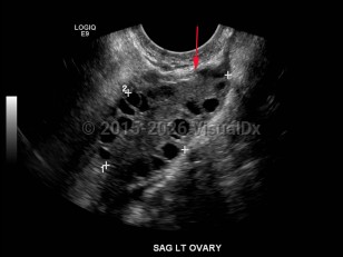 Imaging Studies image of Polyendocrine metabolic ovarian syndrome - imageId=7884589. Click to open in gallery.  caption: '<span>Transvaginal ultrasound demonstrates enlarged ovary with multiple, small peripheral follicles. </span>'