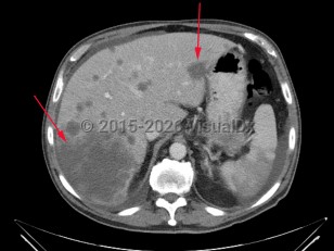 Liver cancer
