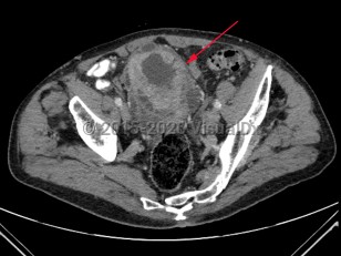 Imaging Studies image of Bladder cancer - imageId=7885454. Click to open in gallery.  caption: '<span>Axial image&nbsp;from an enhanced CT scan of the pelvis  demonstrating marked irregular wall thickening of the bladder.</span>'