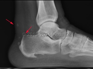 Achilles tendonitis
