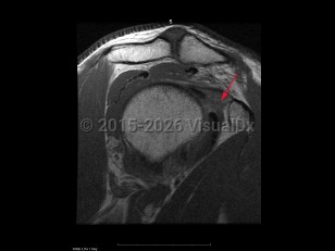 Adhesive capsulitis of the shoulder