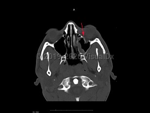 Blow-out fracture of orbit