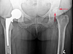 Imaging Studies image of Avascular necrosis of hip - imageId=7893859. Click to open in gallery.  caption: '<span>Serpiginous geographic  sclerosis with lucent center involving the subchondral portion of the  left femoral head compatible with AVN.</span>'