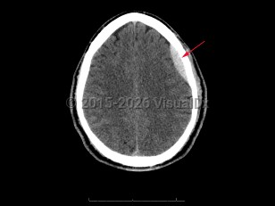 Imaging Studies image of Epidural intracranial hematoma - imageId=7904077. Click to open in gallery.  caption: '<span>Axial CT image demonstrates a  hyperattenuating extra-axial collection in the left frontal region. In  this post-traumatic patient, findings consistent with epidural hematoma.</span>'